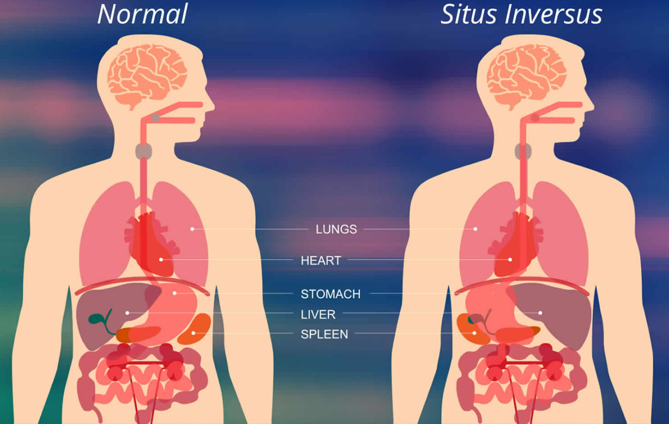 situs inversus totalis nedir